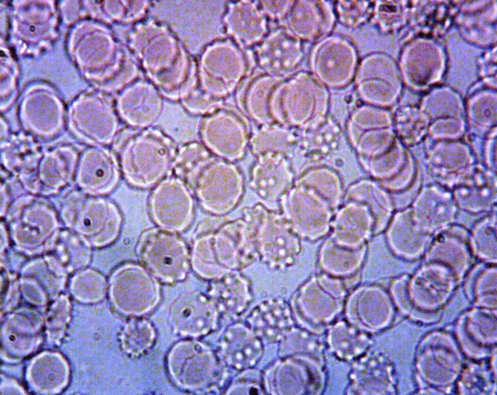 Enlargement of blood cells